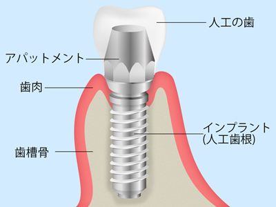 インプラントの構造