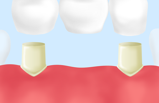 ブリッジ治療