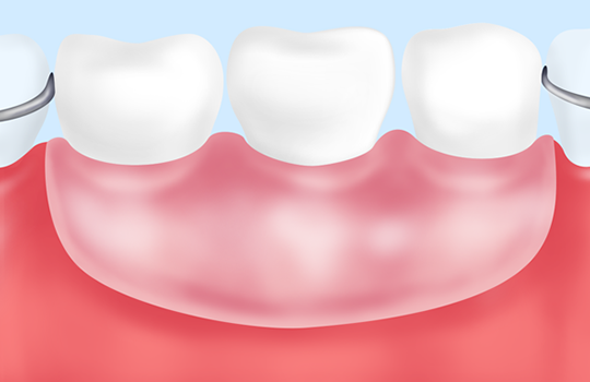 入れ歯治療