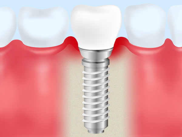インプラント周囲炎とはs