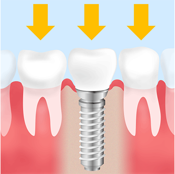 インプラント治療部分の被せ物が壊れる・インプラントが脱落する