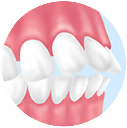 上下の歯が前に突き出ている 上下顎前突（両顎前突）