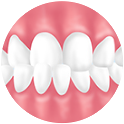歯の中心が左右にずれている 交叉咬合（クロスバイト）