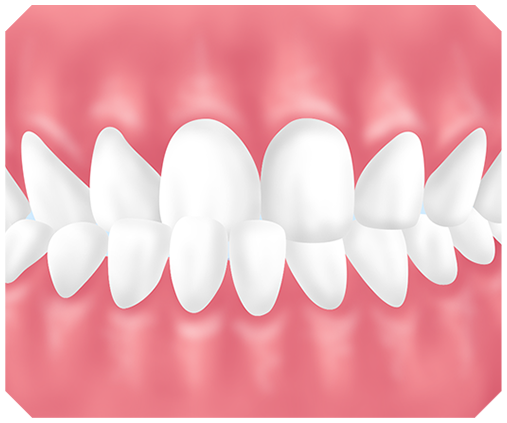 交叉咬合とは