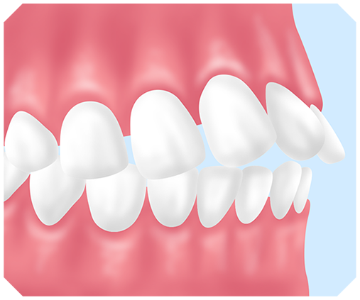 出っ歯とは