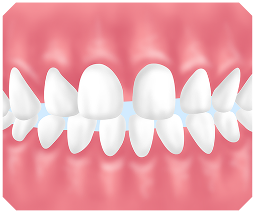 すきっ歯とは