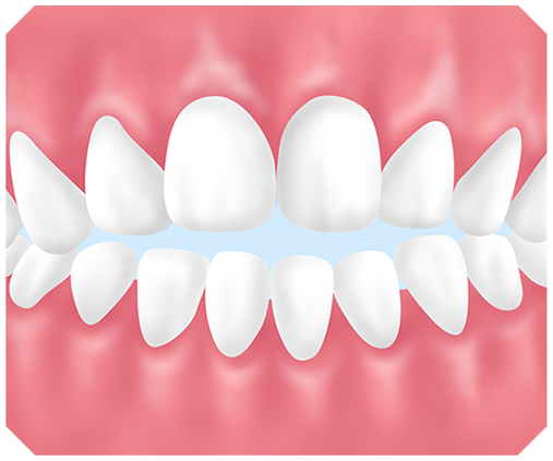 開咬とは？
