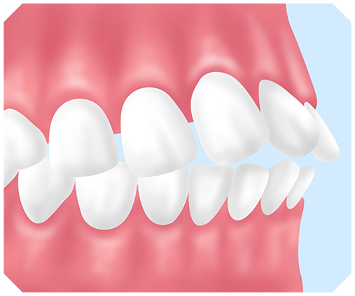 上下顎前突とは