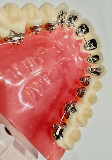 見えにくい裏側矯正実績で限られた存在