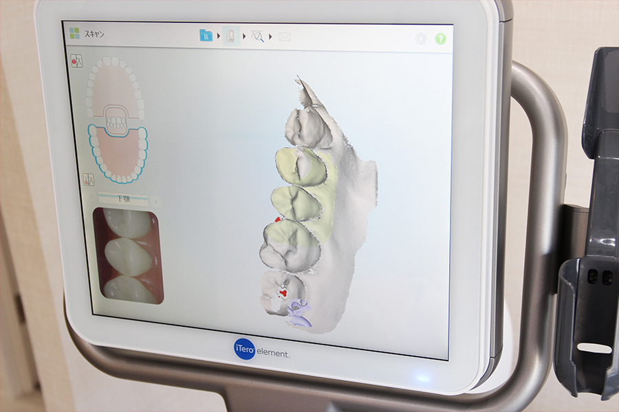 3Dスキャンで歯型データを採取し、専用ソフトウェアでシミュレーションします