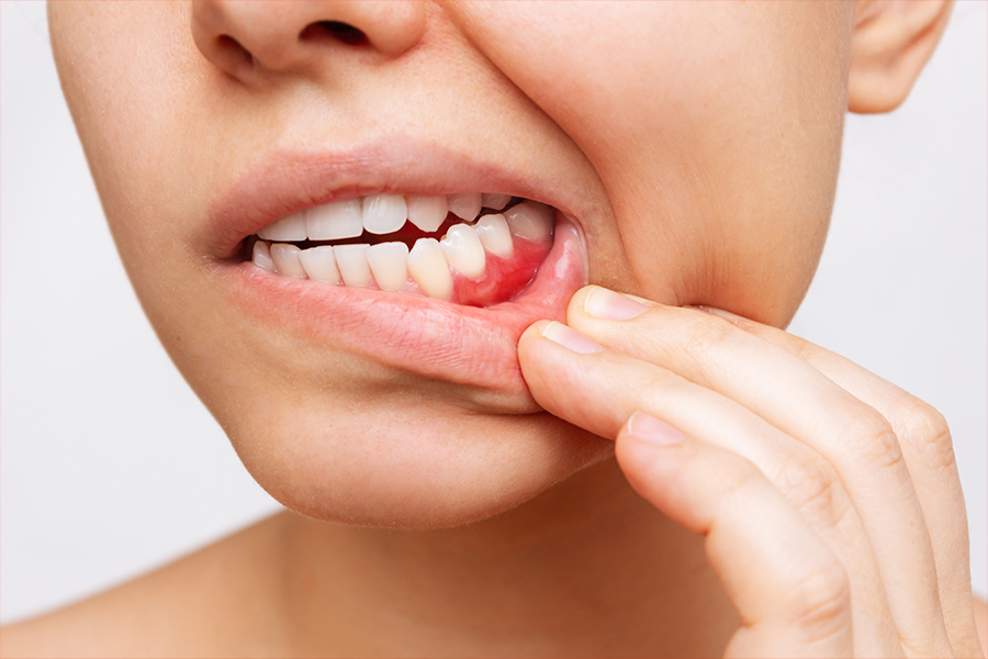 虫歯・歯周病のリスク