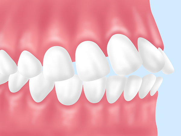 上下顎前突（じょうげがくぜんとつ）
