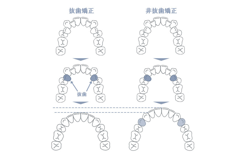 抜歯をするかしないかは、患者様と相談し決定します