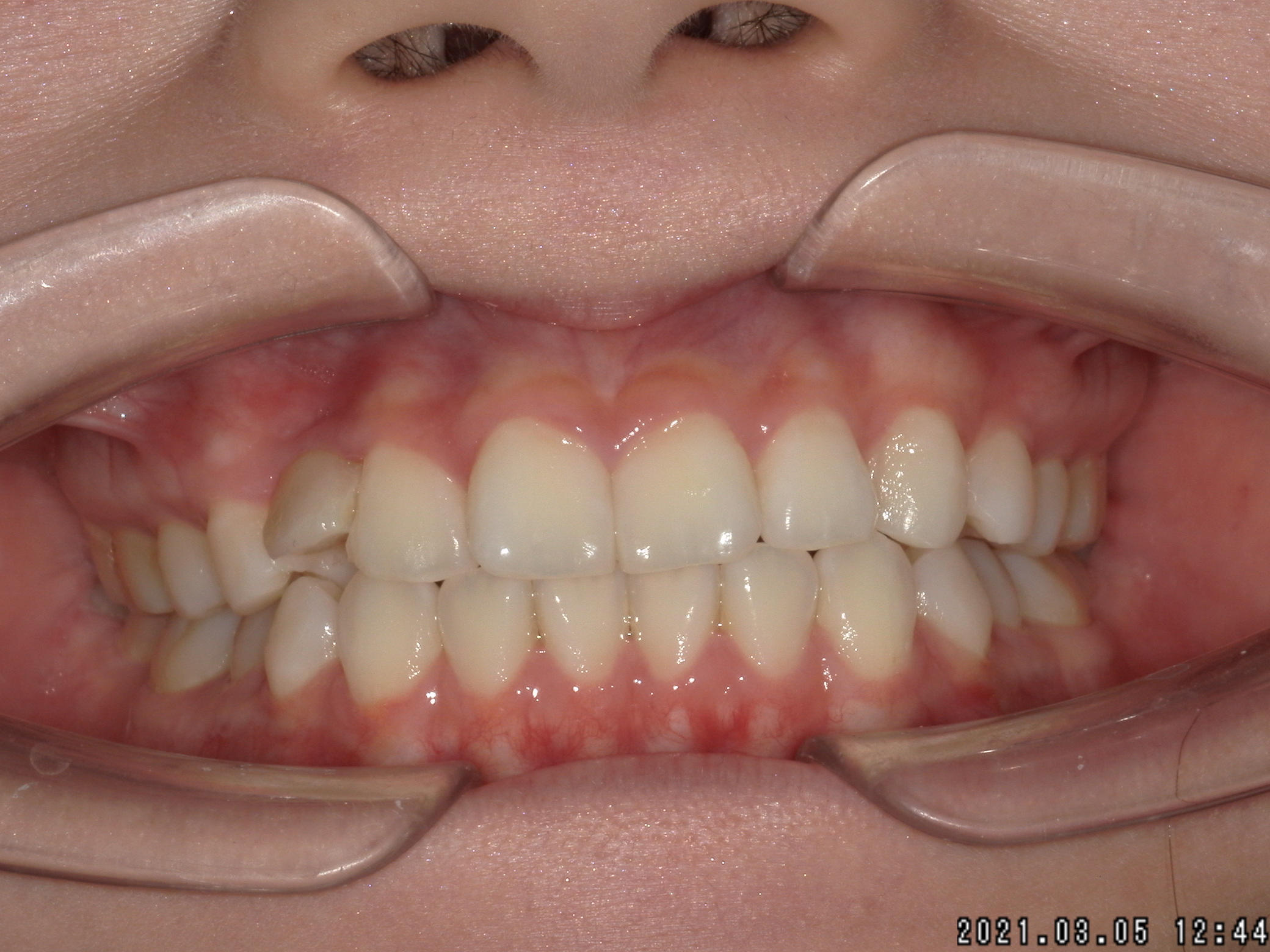 「大人の歯が少ない」に対し表側矯正装置にて治療した症例