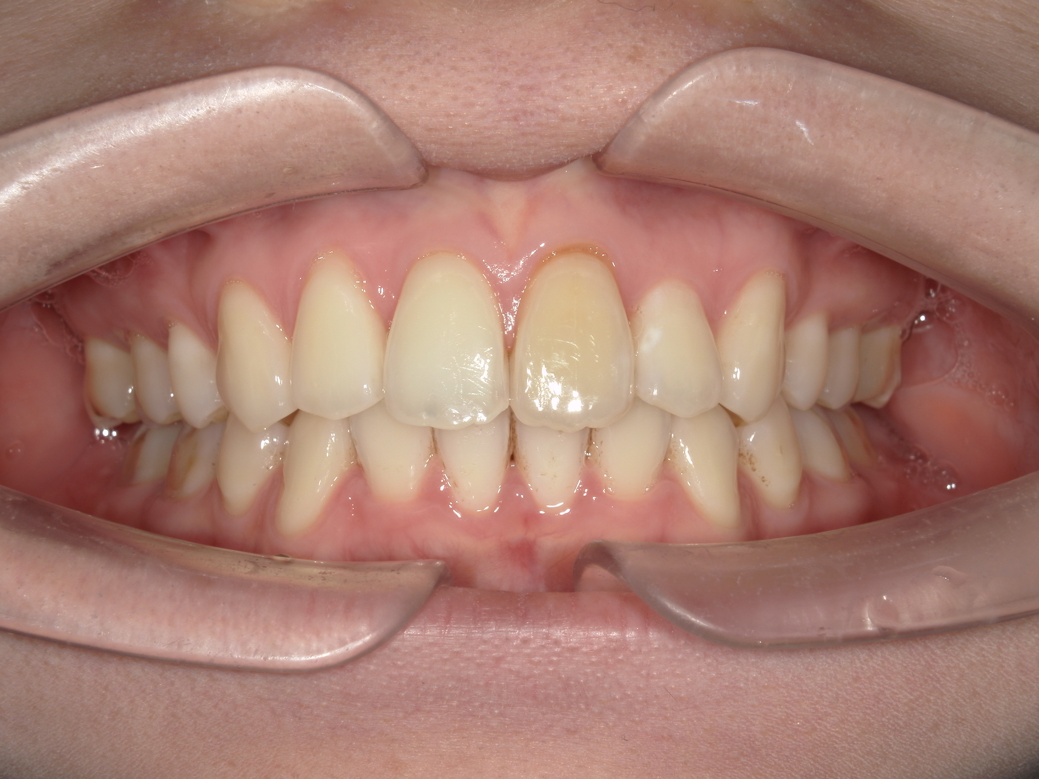 「歯の神経を取った歯の変色が気になる」の主訴に対しホワイトニングにて治療した症例